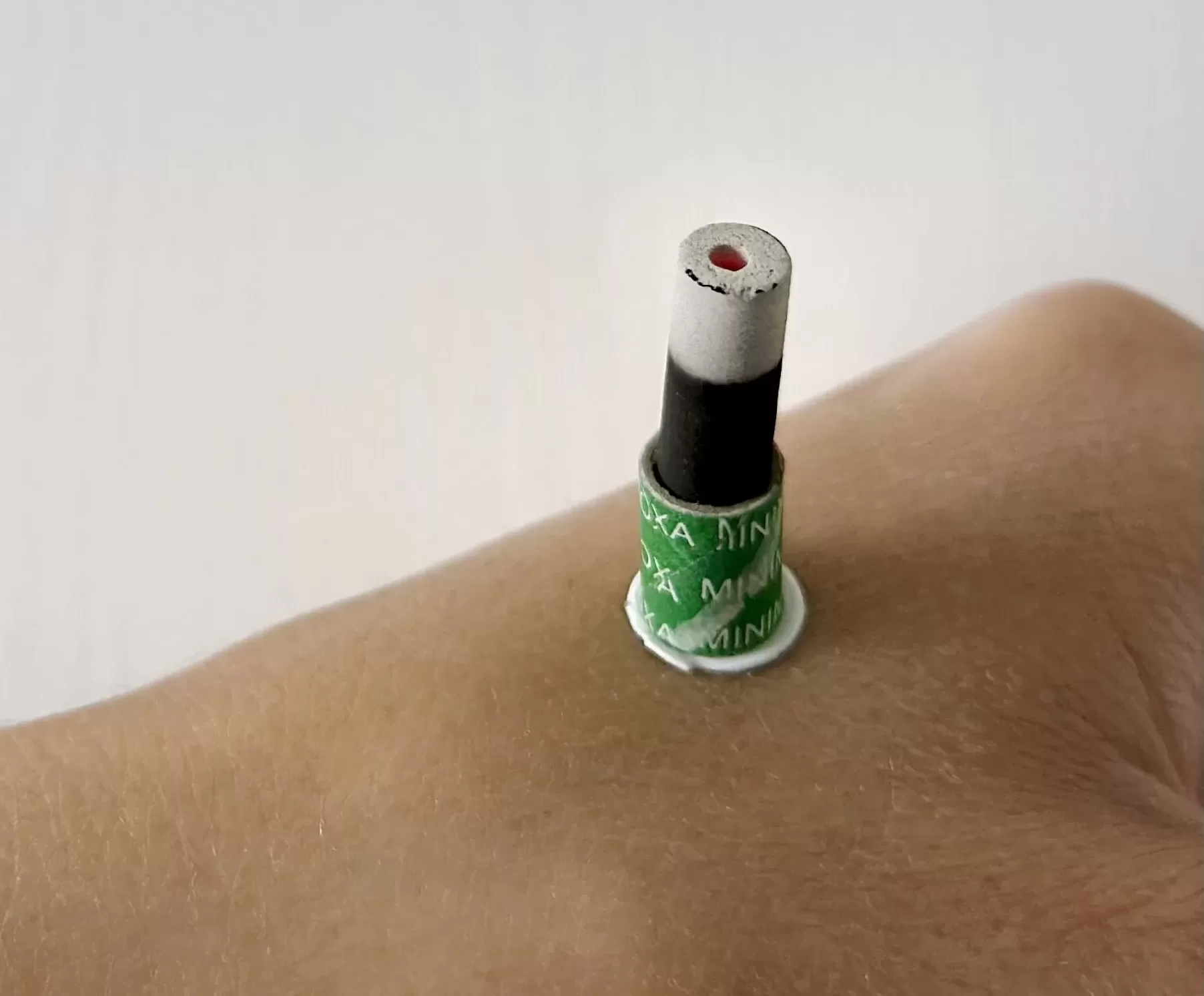 Моксотерапия