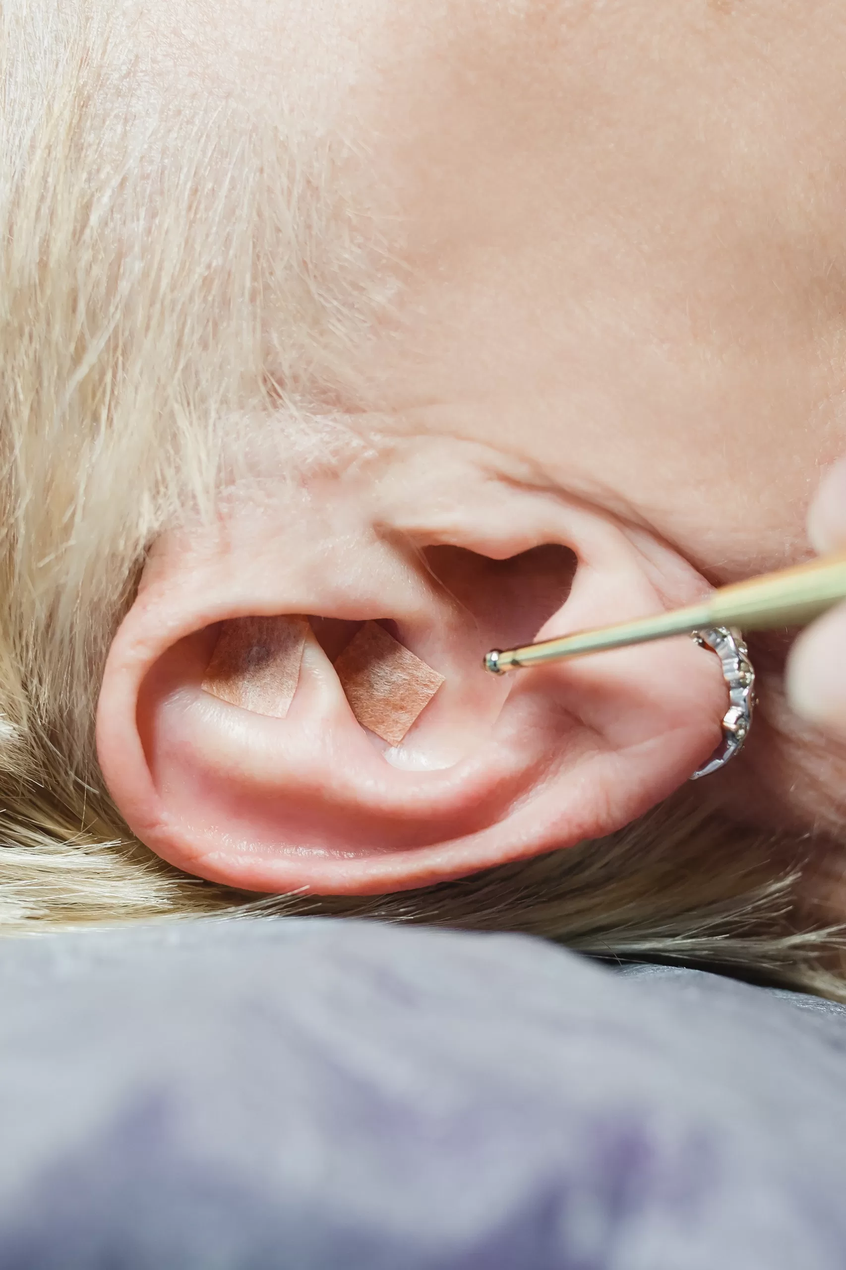 Аурикулотерапия