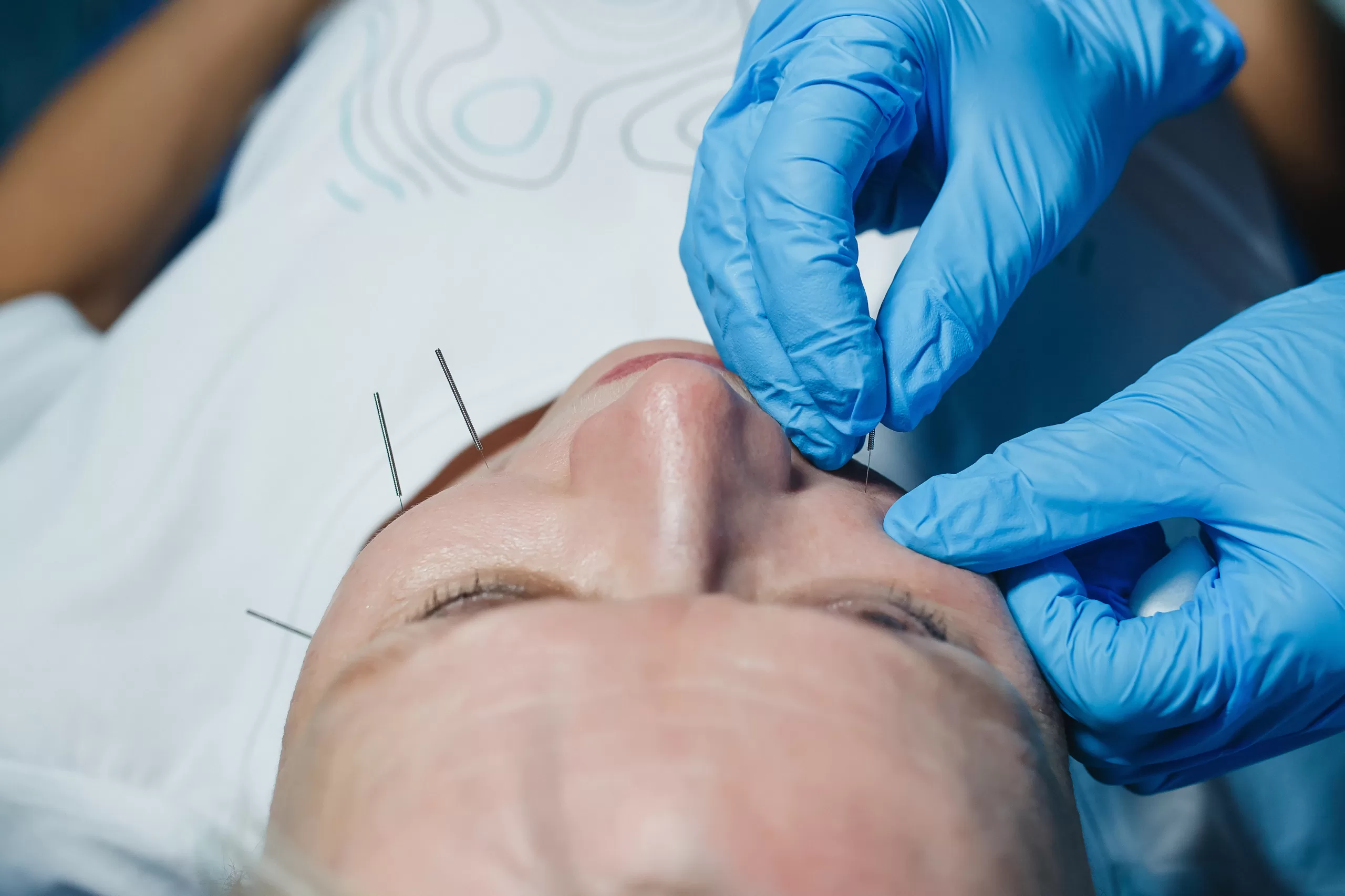 Акупунктурный фейслифтинг